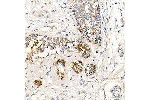 Immunohistochemistry of paraffin-embedded human breast cancer using MMP7 Rabbit mAb (ABIN7268425) at dilution of 1:150 (40x lens). (MMP7 抗体)