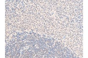 Immunohistochemistry (IHC) image for anti-Receptor tyrosine-protein kinase erbB-2 (ErbB2/Her2) (pTyr1112) antibody (ABIN6255774)