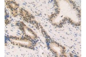 Detection of HMGN2 in Human Stomach cancer Tissue using Polyclonal Antibody to High Mobility Group Nucleosome Binding Domain Containing Protein 2 (HMGN2)