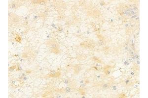 ABIN7096982 and ABIN7101049 at 1/100 staining human astrocytoma by IHC-P. (PROZ 抗体)