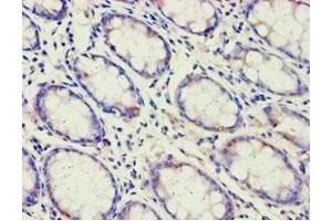 Immunohistochemistry of paraffin-embedded human colon cancer using ABIN7143191 at dilution of 1:100 (ACAD9 抗体  (AA 1-270))