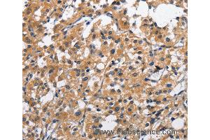 Immunohistochemistry of Human liver cancer using CLEC2D Polyclonal Antibody at dilution of 1:70 (CLEC2D 抗体)