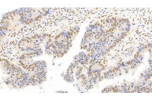 Detection of FOXP3 in Human Colorectal cancer Tissue using Monoclonal Antibody to Forkhead Box P3 (FOXP3) (FOXP3 抗体  (AA 191-412))