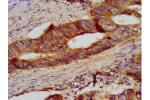IHC image of ABIN7145452 diluted at 1:300 and staining in paraffin-embedded human colon cancer performed on a Leica BondTM system. (CSN2 抗体  (AA 16-226))