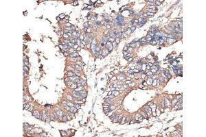 Immunohistochemistry of paraffin-embedded Human colon carcinoma using KRT81 Polyclonal Antibody at dilution of 1:100 (40x lens). (KRT81 抗体)