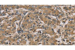 Immunohistochemistry of paraffin-embedded Human liver cancer using MYL3 Polyclonal Antibody at dilution of 1:45 (MYL3/CMLC1 抗体)