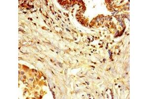 Immunohistochemistry of paraffin-embedded human breast cancer using ABIN7150005 at dilution of 1:100 (Diphthamide Biosynthesis 7 (DPH7) (AA 210-325) 抗体)