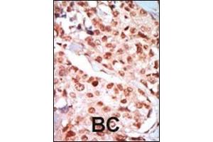 Formalin-fixed and paraffin-embedded human cancer tissue reacted with the primary antibody, which was peroxidase-conjugated to the secondary antibody, followed by DAB staining. (PRKAA2 抗体  (AA 265-295))