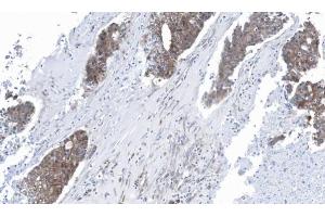IHC-P Image Immunohistochemical analysis of paraffin-embedded human ovarian cancer, using GLO1, antibody at 1:100 dilution. (GLO1 抗体)