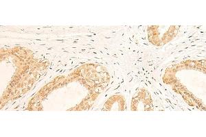 Immunohistochemistry of paraffin-embedded Human breast cancer tissue using IFI35 Polyclonal Antibody at dilution of 1:35(x200) (IFI35 抗体)