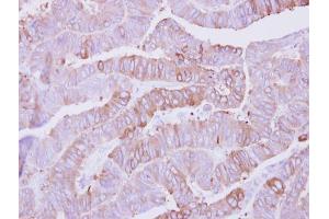 IHC-P Image Immunohistochemical analysis of paraffin-embedded human colon carcinoma, using Casein Kinase 1 alpha 1L, antibody at 1:500 dilution. (CSNK1A1L 抗体)