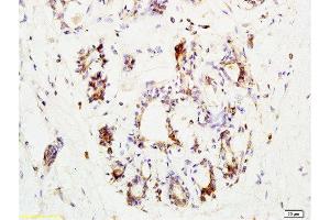 Formalin-fixed and paraffin embedded human breast carcinoma labeled with Anti-CCR3 Polyclonal Antibody, Unconjugated  at 1:200 followed by conjugation to the secondary antibody and DAB staining. (CCR3 抗体  (AA 251-355))