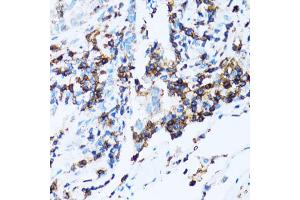 Immunohistochemistry of paraffin-embedded human lung cancer using SPN antibody (ABIN5973813) at dilution of 1/100 (40x lens). (CD43 抗体)