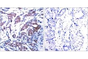 Immunohistochemistry analysis of paraffin-embedded human breast carcinoma, using c-Jun (Phospho-Ser73) Antibody. (C-JUN 抗体  (AA 40-89))
