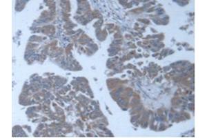 IHC-P analysis of Human Liver Cancer Tissue, with DAB staining. (POFUT1 抗体  (AA 238-388))