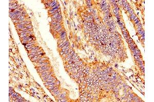 IHC image of ABIN7145294 diluted at 1:400 and staining in paraffin-embedded human colon cancer performed on a Leica BondTM system. (BCL2L1 抗体  (AA 1-209))
