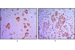 Immunohistochemical analysis of paraffin-embedded human brain tissue (A) and breast tumor (B) uing ETS1 mouse mAb. (ETS1 抗体)