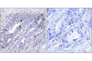 Immunohistochemistry analysis of paraffin-embedded human colon carcinoma tissue, using Nuclear Receptor NR4A1 (Ab-351) Antibody. (NR4A1 抗体  (AA 317-366))