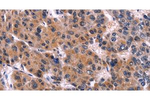 Immunohistochemistry of paraffin-embedded Human liver cancer tissue using EIF2AK4 Polyclonal Antibody at dilution 1:50 (GCN2 抗体)