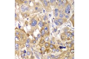 Immunohistochemistry of paraffin-embedded human esophageal cancer using PPP1CB antibody at dilution of 1:100 (400x lens). (PPP1CB 抗体)