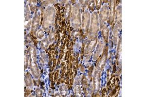 Immunohistochemistry of paraffin-embedded human colon carcinoma using Caspase-8 Rabbit pAb (ABIN6131530, ABIN6137970, ABIN6137972 and ABIN6213676) at dilution of 1:200 (40x lens). (Caspase 8 抗体  (AA 1-479))