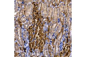 Immunohistochemistry of paraffin-embedded human colon carcinoma using Caspase-8 Rabbit pAb (ABIN6131530, ABIN6137970, ABIN6137972 and ABIN6213676) at dilution of 1:200 (40x lens).
