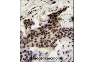 UBXN2A Antibody (C-term) (ABIN655308 and ABIN2844890) immunohistochemistry analysis in formalin fixed and paraffin embedded human bladder carcinoma followed by peroxidase conjugation of the secondary antibody and DAB staining. (UBXN2A 抗体  (C-Term))