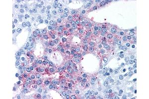 Anti-GPRC6A antibody IHC of human Prostate, Carcinoma. (GPRC6A 抗体  (N-Term))