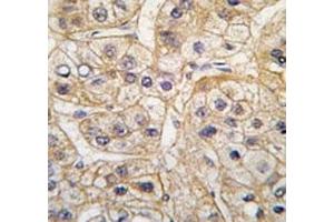 IHC analysis of FFPE human hepatocarcinoma tissue stained with the EGF Receptor antibody (EGFR 抗体  (AA 1048-1077))