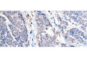 Immunohistochemistry of paraffin-embedded Human thyroid cancer tissue using TRIM27 Polyclonal Antibody at dilution of 1:65(x200) (TRIM27 抗体)