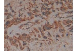 Detection of FADD in Human Lung cancer Tissue using Polyclonal Antibody to Fas Associating Death Domain Containing Protein (FADD) (FADD 抗体  (AA 12-206))