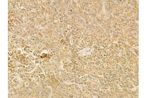 ABIN6263787 and ABIN6278498 at 1/100 staining human hepatocellular carcinoma by IHC-P. (SLC22A6 抗体  (Internal Region))