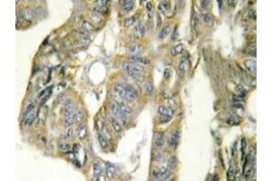 Immunohistochemistry analysis of TNF-alpha Antibody in paraffin-embedded human colon carcinoma tissue. (TNF alpha 抗体)
