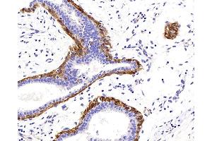 Immunohistochemistry analysis of paraffin-embedded human breast cancer using TAGLN Polyclonal Antibody at dilution of 1:400. (Transgelin 抗体)