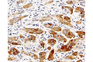 Immunohistochemistry analysis of paraffin-embedded human liver cancer using CASP1 Polyclonal Antibody at dilution of 1:300.