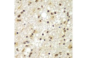 Immunohistochemistry of paraffin-embedded human brain cancer using ZNF20 antibody at dilution of 1:100 (x400 lens). (ZNF20 抗体)