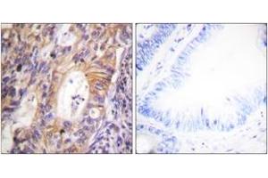 Immunohistochemistry analysis of paraffin-embedded human colon carcinoma, using c-Met (Phospho-Tyr1003) Antibody. (c-MET 抗体  (pTyr1003))