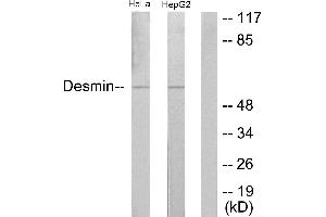 Immunohistochemistry analysis of paraffin-embedded human colon carcinoma tissue using Desmin (Ab-60) antibody. (Desmin 抗体)