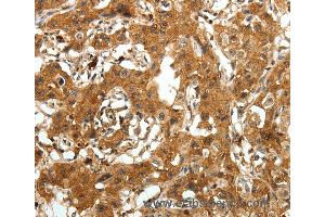 Immunohistochemistry of Human lung cancer using AMD1 Polyclonal Antibody at dilution of 1:30 (AMD1 抗体)