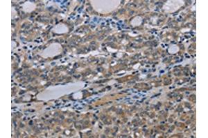 The image on the left is immunohistochemistry of paraffin-embedded Human thyroid cancer tissue using ABIN7191523(MT-ND3 Antibody) at dilution 1/30, on the right is treated with synthetic peptide. (MT-ND3 抗体)