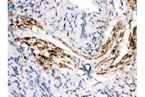 Anti- MAOB Picoband antibody,IHC(P) IHC(P): Human Lung Cancer Tissue (Monoamine Oxidase B 抗体  (C-Term))