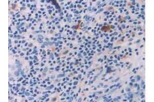 DAB staining on IHC-P; Samples: Human Skin cancer Tissue (IL-18 抗体  (AA 37-193))