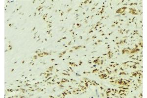 ABIN6269139 at 1/100 staining Human breast cancer tissue by IHC-P. (Src 抗体)