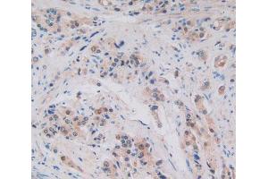 Used in DAB staining on fromalin fixed paraffin- embedded prostate gland cancer tissue (ALOX15B 抗体  (AA 253-490))
