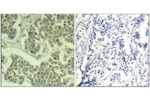 Immunohistochemical analysis of paraffin-embedded human breast carcinoma tissue using eIF2α (Phospho-Ser49) Antibody (left) or the same antibody preincubated with blocking peptide (right). (EIF2S1 抗体  (pSer49))