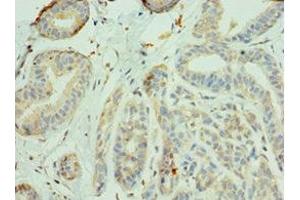 Immunohistochemistry of paraffin-embedded human breast cancer using ABIN7156335 at dilution of 1:100 (IRS1 抗体  (AA 1-160))
