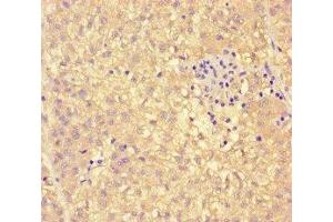Immunohistochemistry of paraffin-embedded human liver cancer using ABIN7163147 at dilution of 1:100 (PEBP4 抗体  (AA 23-227))