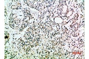 Immunohistochemical analysis of paraffin-embedded human-stomach-cancer, antibody was diluted at 1:200. (EGF 抗体  (AA 1000-1060))