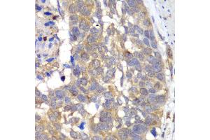 Immunohistochemistry of paraffin-embedded human esophageal cancer using HAPLN1 antibody at dilution of 1:100 (x40 lens).