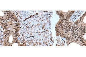 Immunohistochemistry of paraffin-embedded Human colorectal cancer tissue using ZNF787 Polyclonal Antibody at dilution of 1:45(x200) (ZNF787 抗体)